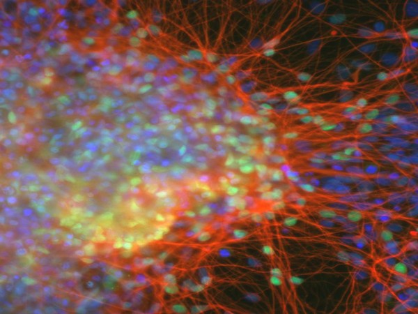 There's too much dietary fat in the intestine, stem cell numbers increase, boosting susceptibility to colon cancer.