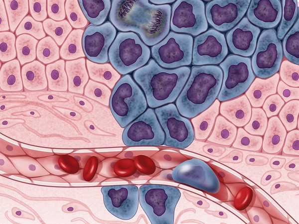 An illustration of cancer cells
