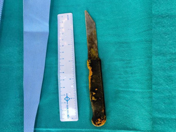 20-cm-knife recovered from a patient's abdomen (Photo/ANI)