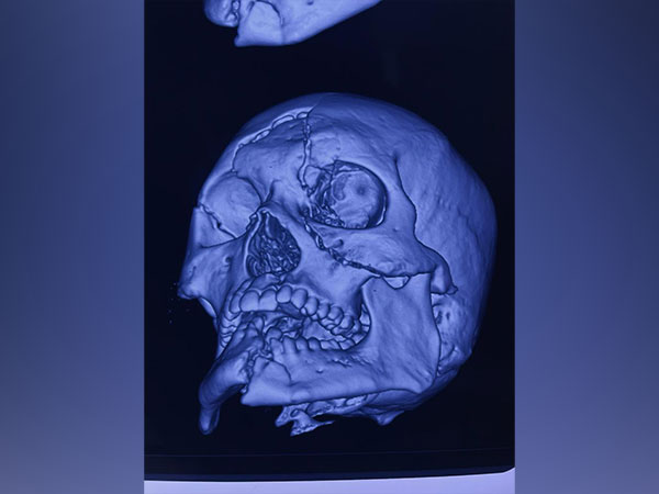 X-ray of skull of man who survived major accident in Delhi (Photo/ANI)