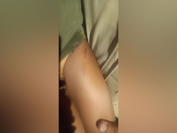 4-year-old injured after stray dogs attack