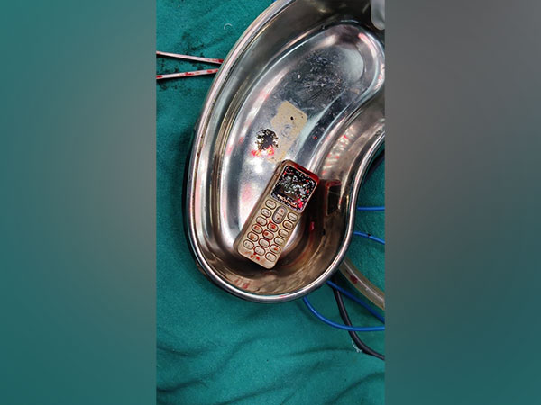Mobile phone taken out from the girl's stomach after operation 