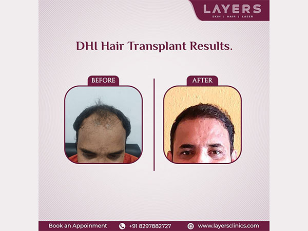 DHI allows surgeons to cut and implant hair follicles at the same time, making hair transplantation faster