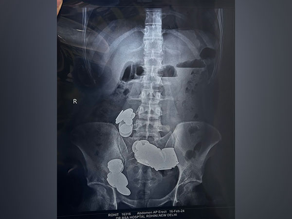 X-Ray image of patient's abdomen