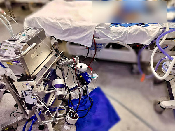 11-year-old gets second life with help of artificial heart and lung technology (Photo/ANI)