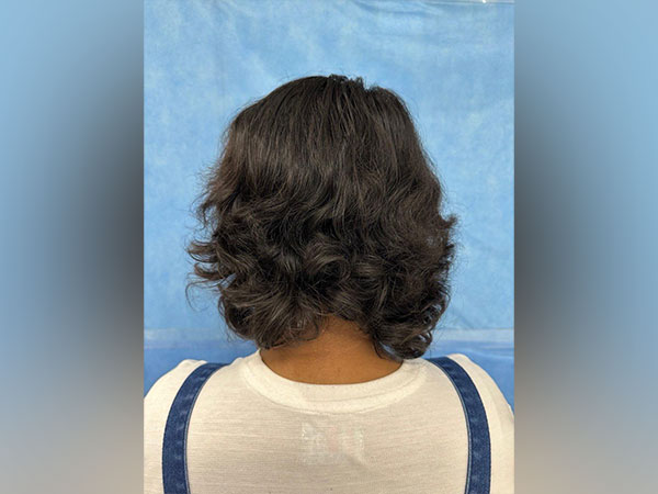 Faridabad doctors perform scalp replantation surgery on 13-year-old girl (Photo/ANI)