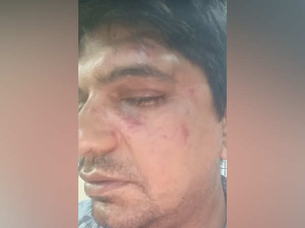 Photo provided by the man who alleged assault on him in Bengaluru (Photo/ANI)