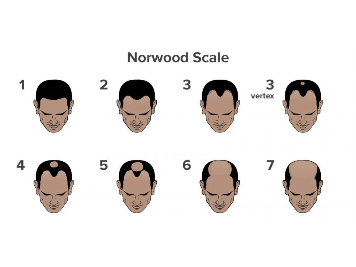 What is Causing Your Hair Fall? Take This Scientifically Backed Hair Loss Quiz What is Causing Your Hair Fall? Take This Scientifically Backed Hair Loss Quiz