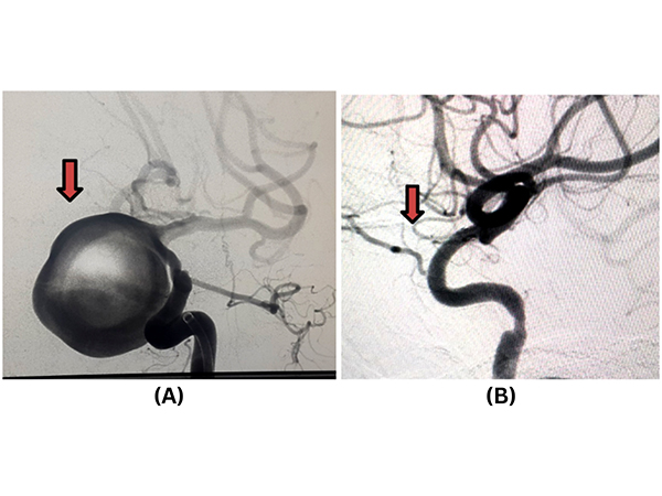 A giant (3.5 cm) aneurysm (A), treated with Flow Divertor Stenting, has disappeared on a 6-month follow-up angiogram (B)
