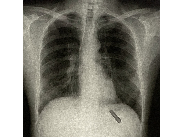 X-ray of the patient (Photo/ANI)