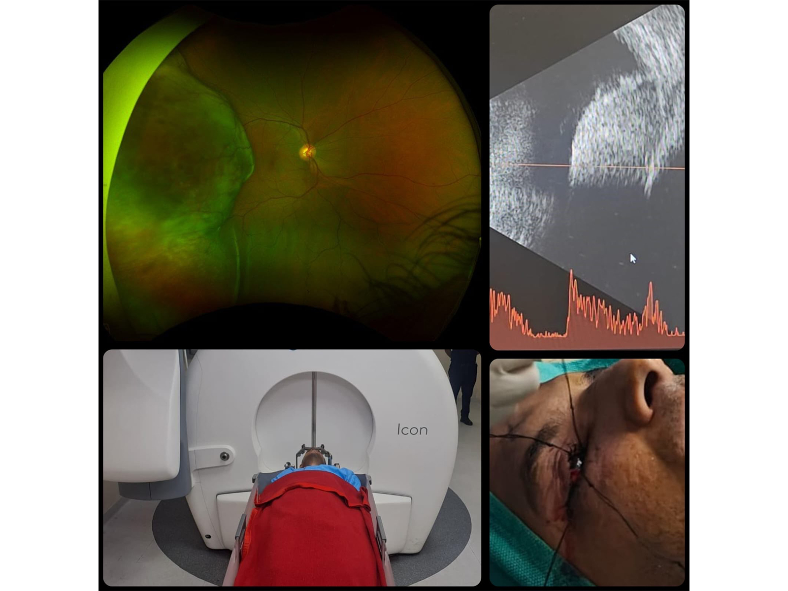Army Hospital R&R performs Gamma Knife Therapy in 38-year-old serving officer (Photo/X/@SpokespersonMoD)
