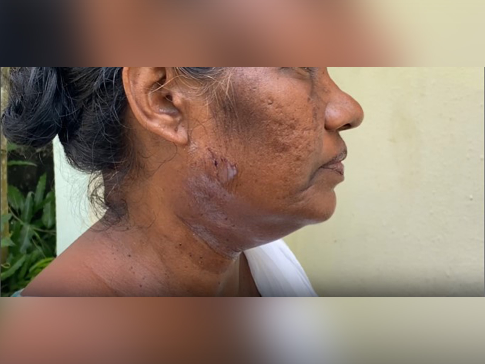 Booth Level Officer in Kottayam, Kerala claimed dog attack during SIR enumeration process (Photo/ANI)