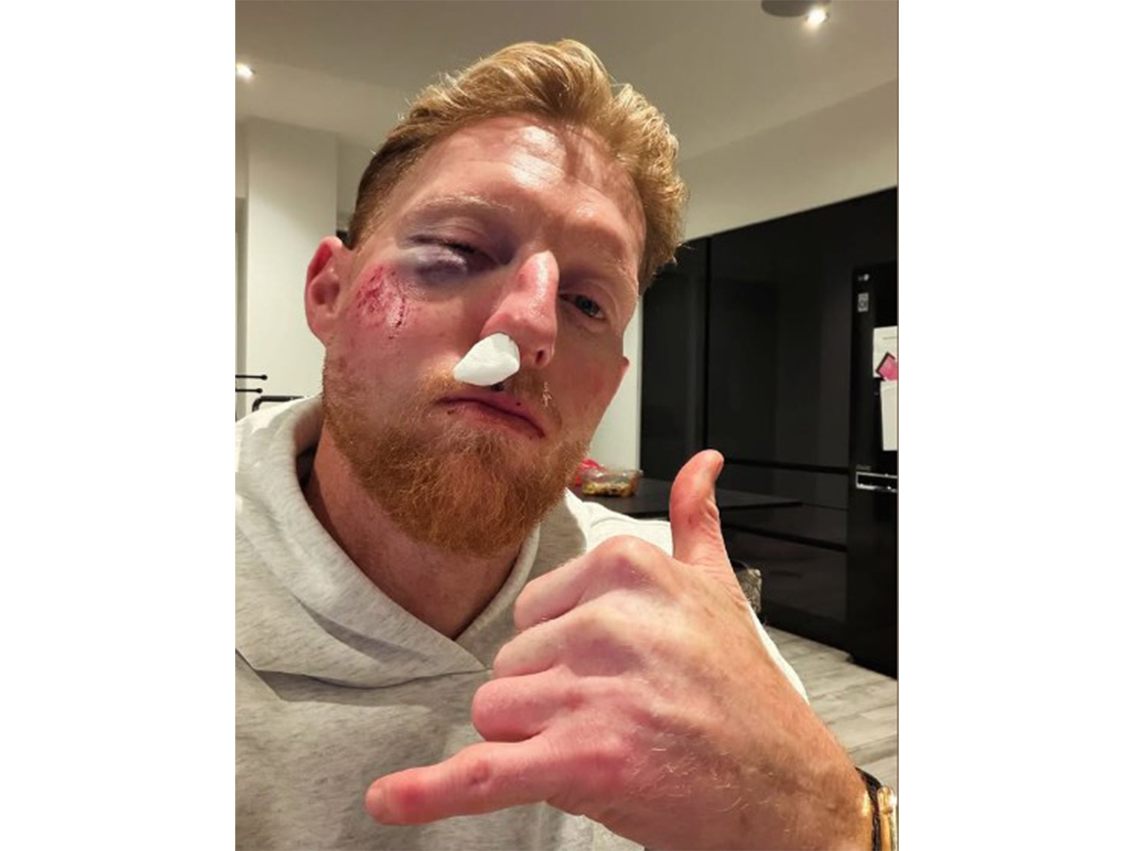 Ben Stokes suffers facial injury. (Photo: Instagram/stokesy)