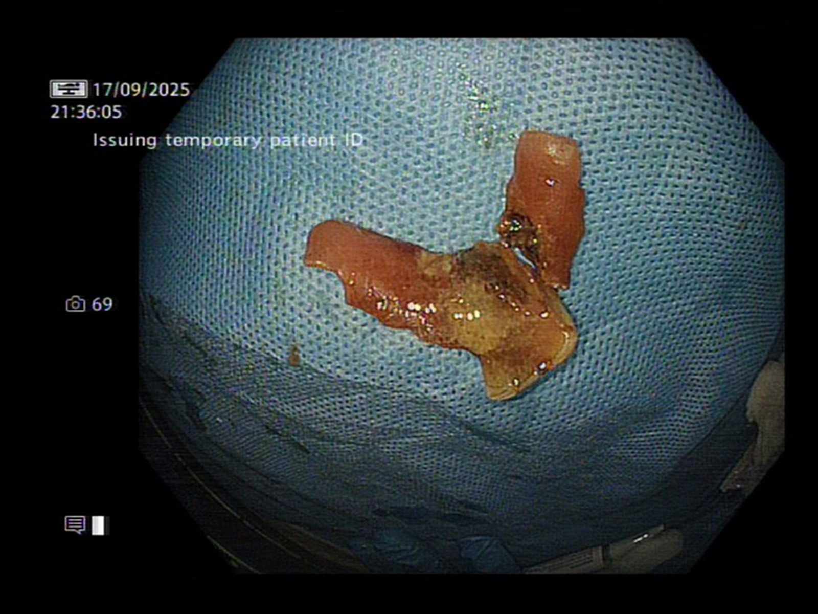 Impacted dental plate lodged inside food pipe (Photo/Sir Gangaram Hospital)