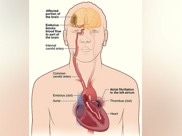 Rapid heartbeat can lead to stroke, heart failure, and other complications.
