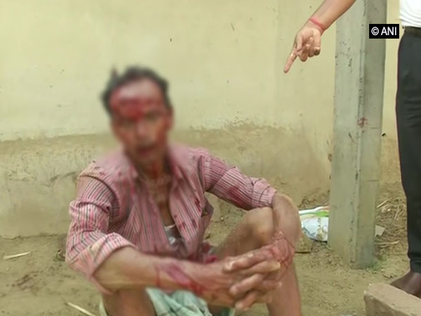 BJP worker injured in clash with TMC workers near booth number 1 in Bankura. Photo/ANI