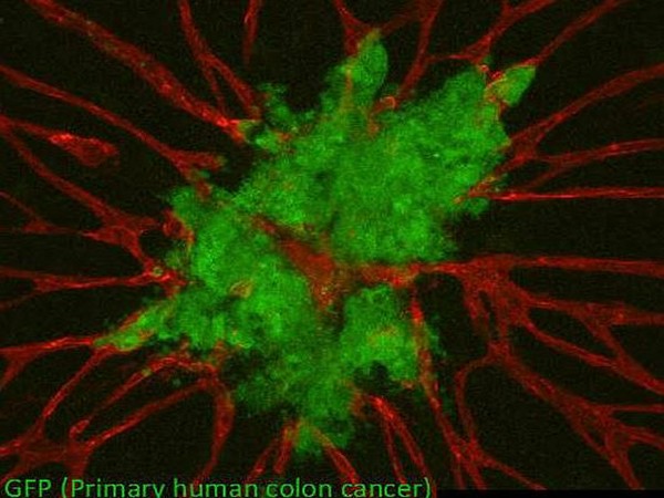 Some colon cancer mutations found in patients can lead to a striking increase in the fertility of the environment surrounding precancerous fields.