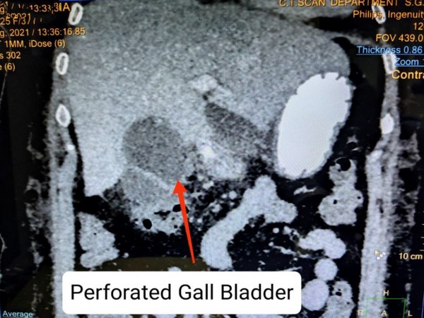 The CT Scan of a patient having post-COVID gall bladder gangrene (Photo/ANI)