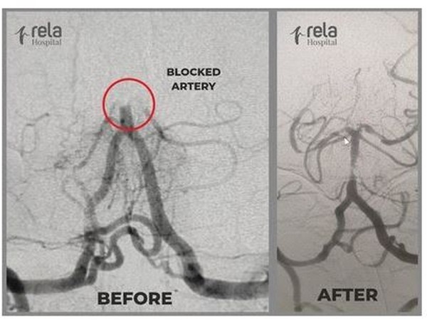 Mechanical Thrombectomy - a treatment of choice for acute ischemic stroke