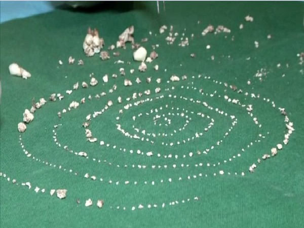 In an astounding development, Chennai doctors extracted 526 teeth from a seven-year-old boy's mouth (Photo/ANI)