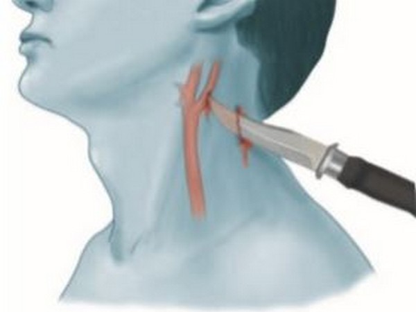 Recreation of the entry wound of the stab wound on the patient