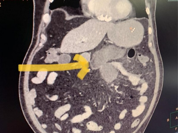 CT scan of a patient's abdomen (Photo/ANI)