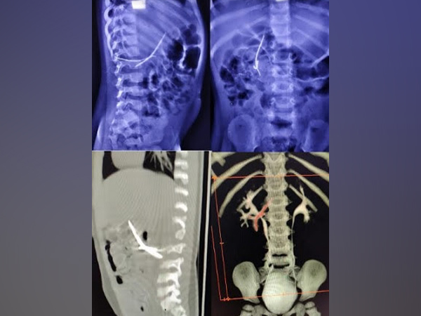 The Department of Pediatric Surgery, Pediatric Urology and Pediatric Minimal Invasive Surgery (Keyhole Surgeries) at Dr. Mehta's Hospitals