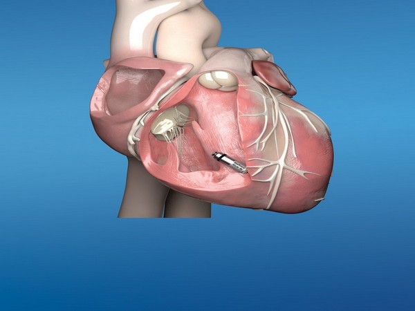 Medtronic Micra(tm) AV - a miniaturized, fully self-contained pacemaker