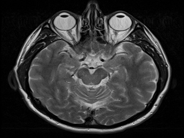 MRI Head Brain 