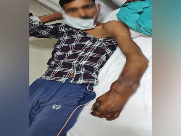 A 36-year-old man, whose forearm got amputated while working in a factory in Delhi's Badli area was later re-joined after a 6-hour surgery.