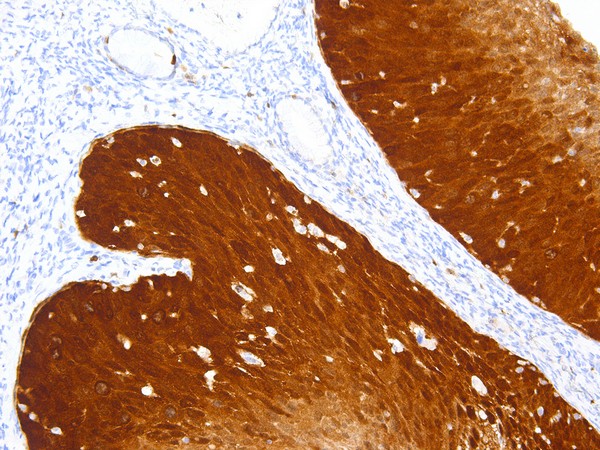 Staining on cervical cancer tissue using antibody clone IHC116