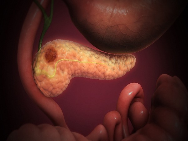 The dreaded pancreatic cancer has the lowest survival rates among all types of cancers.