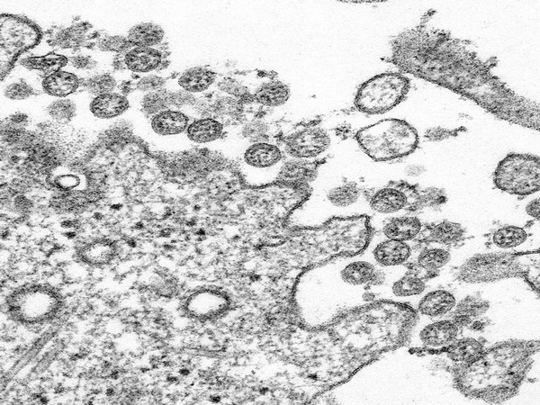 An isolate from the first US case of COVID-19, formerly known as 2019-nCoV or novel coronavirus, is seen in a transmission electron microscopic image obtained from the Centers for Disease Control.