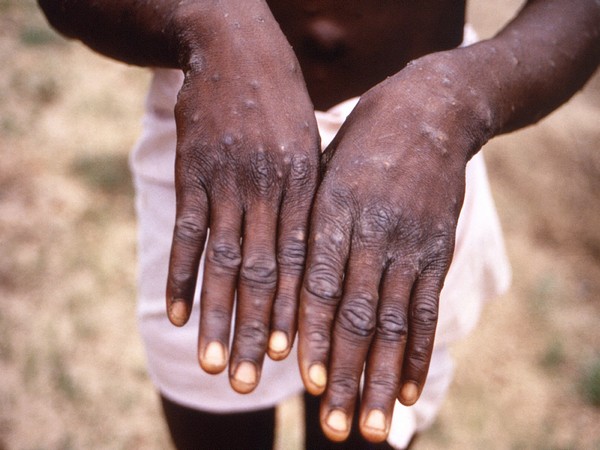
    More than 550 confirmed monkeypox cases reported: UN
    