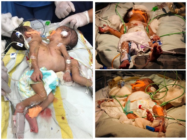 The conjoined twins, before and after the surgery. Photo/ANI