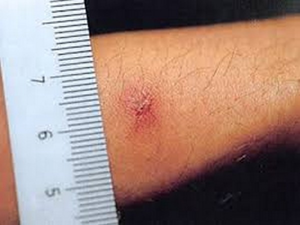 Scrub Typhus (Representative image)