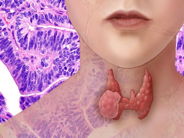 Never ignore lump or swelling in neck: It might be sign of thyroid cancer 