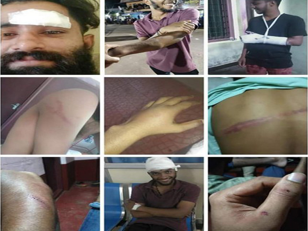 Injury marks on devotees who were beaten up during Theyyam festival in Kerala. Photo/ANI