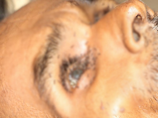 Ants crawling inside an eye of Balchandra Lodhi after his death at Shivpuri district hospital