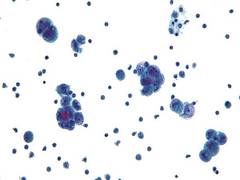 
      
      Researchers now a step closer to potential new cancer treatment 
      
      