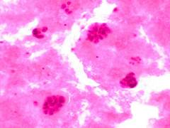 
    Scientists explore women's knowledge about breast density, cancer risk
    
