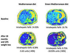 
      
      Green med diet cuts non-alcoholic fatty liver disease by...
      
      