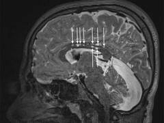 
      
      Brain magnetic resonance imaging enhanced through artificial...
      
      