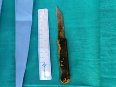 
      
      AIIMS doctors remove 20-cm long kitchen knife from man's abdomen
      
      