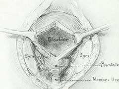 
      
      Individualised physical therapy after prostate surgery can...
      
      