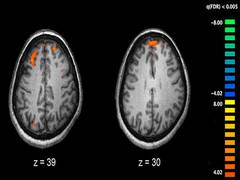 
      
      Researchers find evidence for reduced brain connections in...
      
      