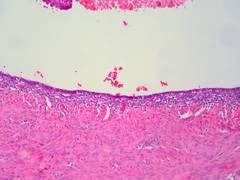 
      
      Study reveals nanotechnology to develop new treatment for...
      
      