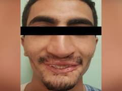 
      
      Mobile blast in mouth injure Yemen youth, gets fresh lease of...
      
      