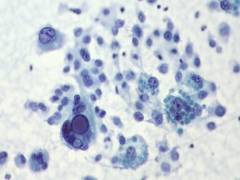 
      
      Study focuses on possible new combination treatment for...
      
      