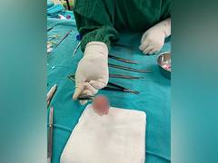 
      
      Rare large fungal ball extracted from elderly patient's aortic heart valve
      
      